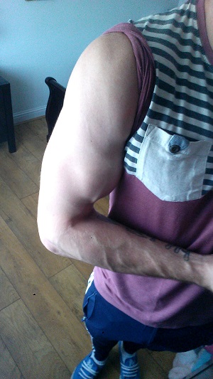 Arm Vascularity (Day 1 end of LGD cycle).jpg