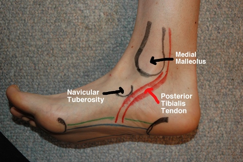 Cause-of-peroneal-tendonitis.jpg