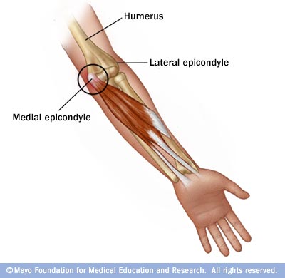Golfers elbow Pain on the inside of the elbow