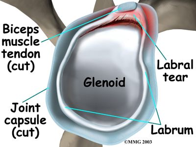 glenoid-labrum-tear.jpg