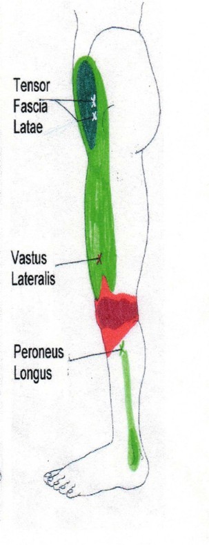 quad trigger point.jpg