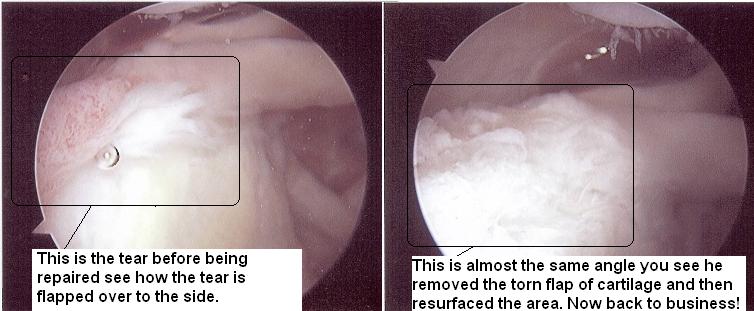 Shoulder Surgery Pics before and after 1-12-2011.jpg