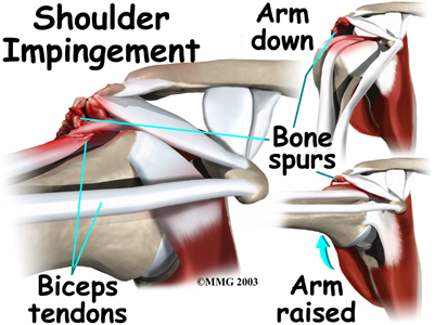shoulder_biceps_rupture_causes01.jpg