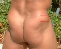 injection spot gluteus medius_.jpg