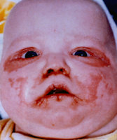 biotindefbaby.jpg