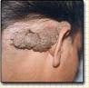 warts.jpg