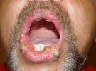 warts2.jpg