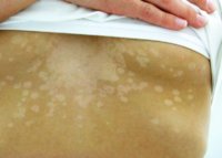 1200px-Tinea_versicolor1.jpg