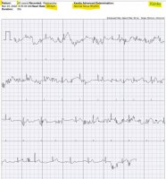 kardia mobile EKG.jpg