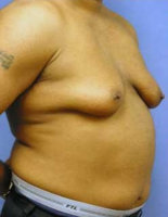 gynecomastia-surgery-4.jpg