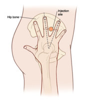 ventrogluteal.jpg