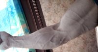 Post IHOP Veins.jpg