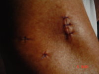Post Op..JPG