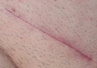 Scar-011708.2.jpg